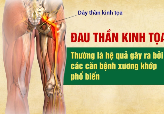  NHỮNG AI DỄ BỊ ĐAU THẦN KINH TOẠ?